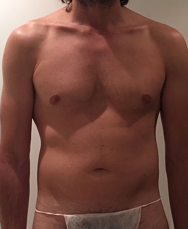 360° abdominal liposuction — Before · front view