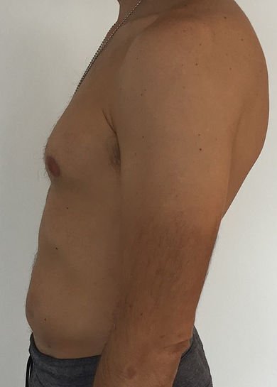 360° abdominal liposuction — After · oblique view