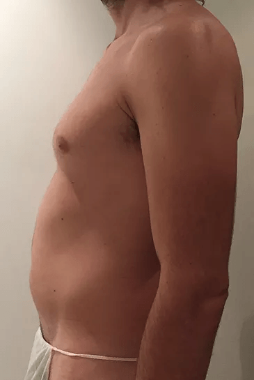 360° abdominal liposuction — Before · oblique view