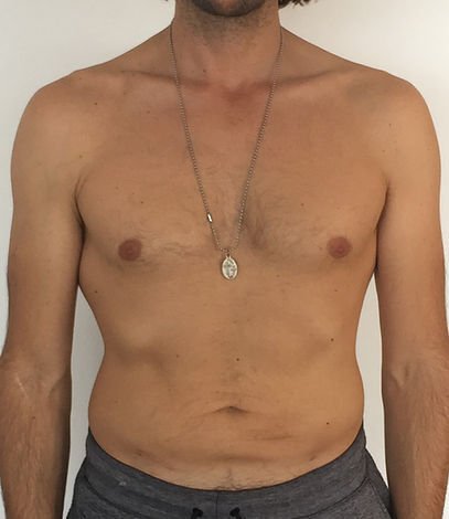 360° abdominal liposuction — After · front view