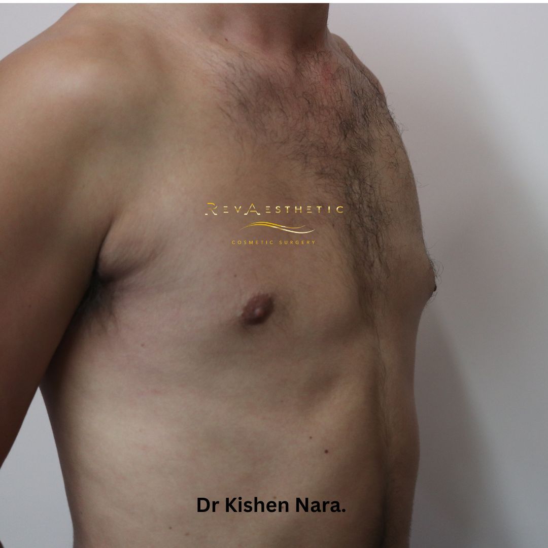 Left-sided gynaecomastia surgery — Anterior view — after
