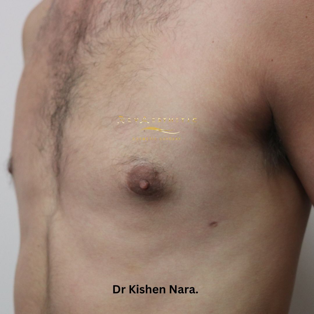 Left-sided gynaecomastia surgery — oblique view — after