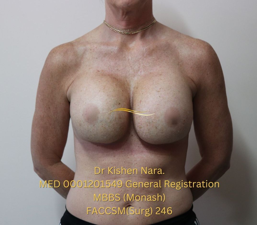 Revision breast implants — Anterior view — after