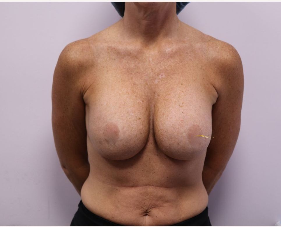 Revision breast implants — Anterior view — before