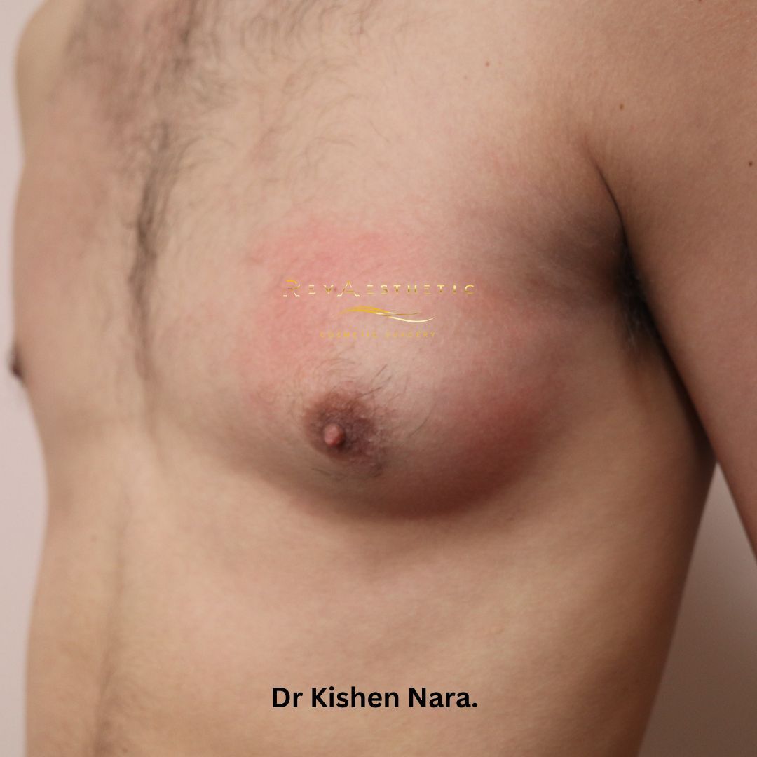 Left-sided gynaecomastia surgery — oblique view — before