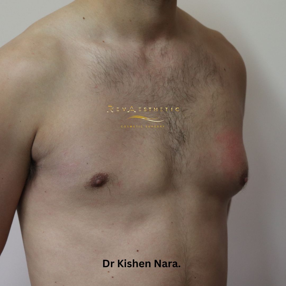 Left-sided gynaecomastia surgery — Anterior view — before