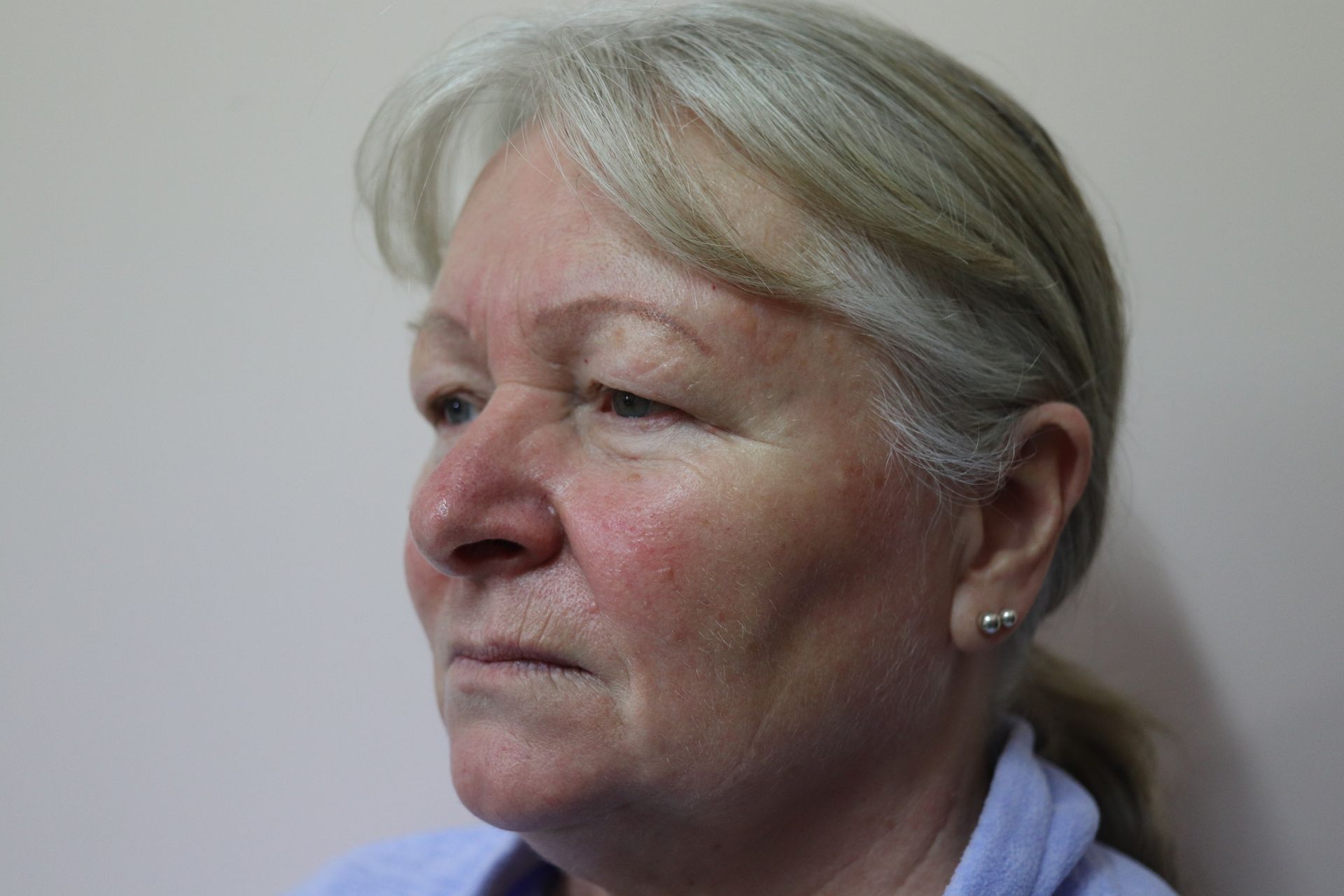 Revision upper blepharoplasty with brow lift — 5 months post-procedure — before