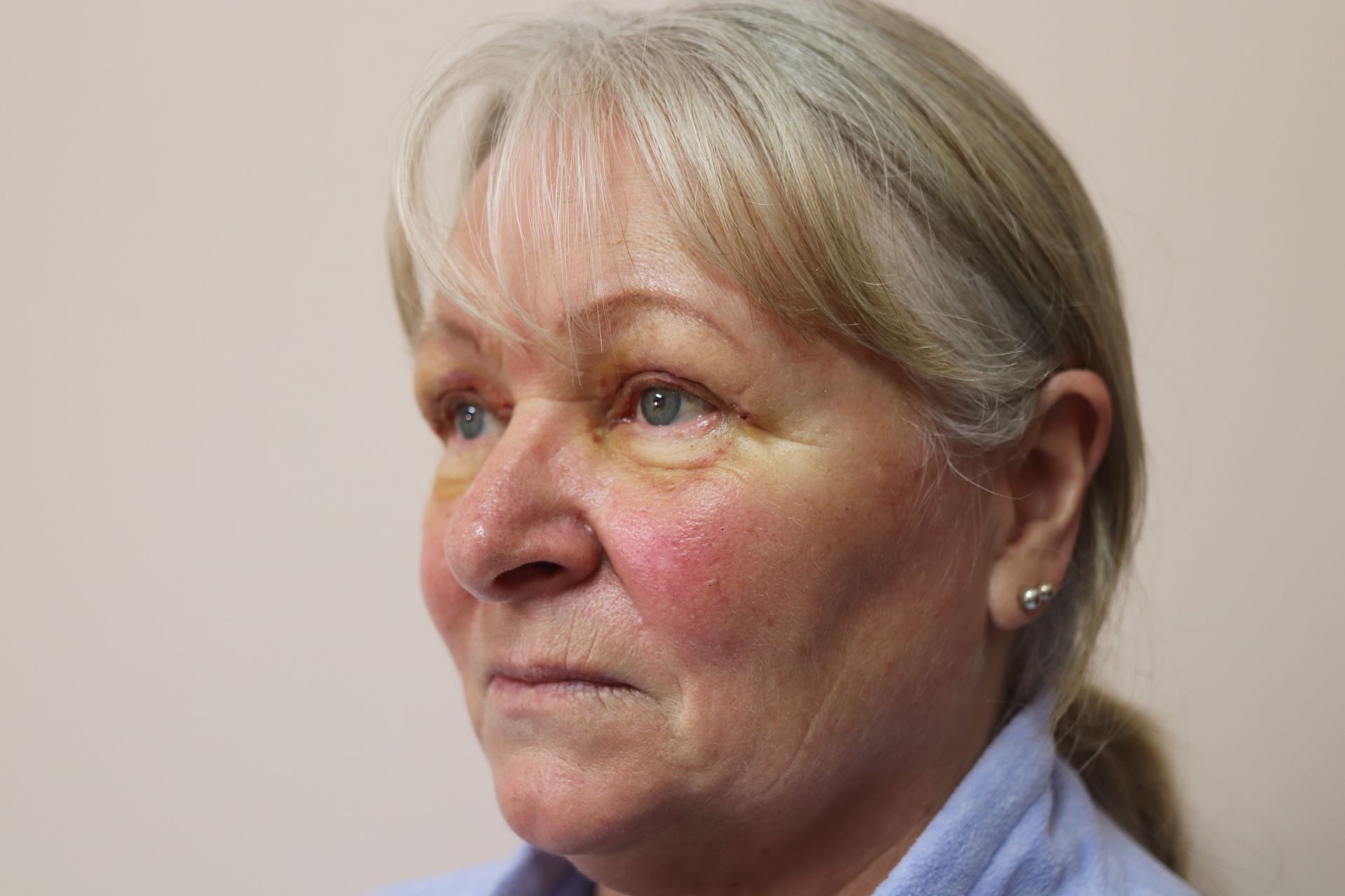 Revision upper blepharoplasty with brow lift — 5 months post-procedure — after