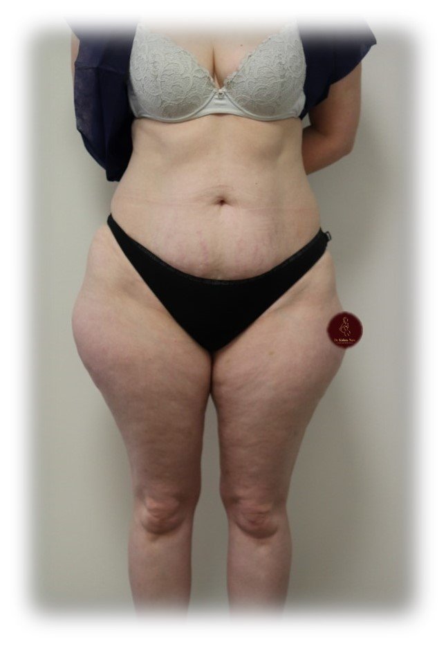 Outer-thigh liposuction — Before · outer-thigh contour