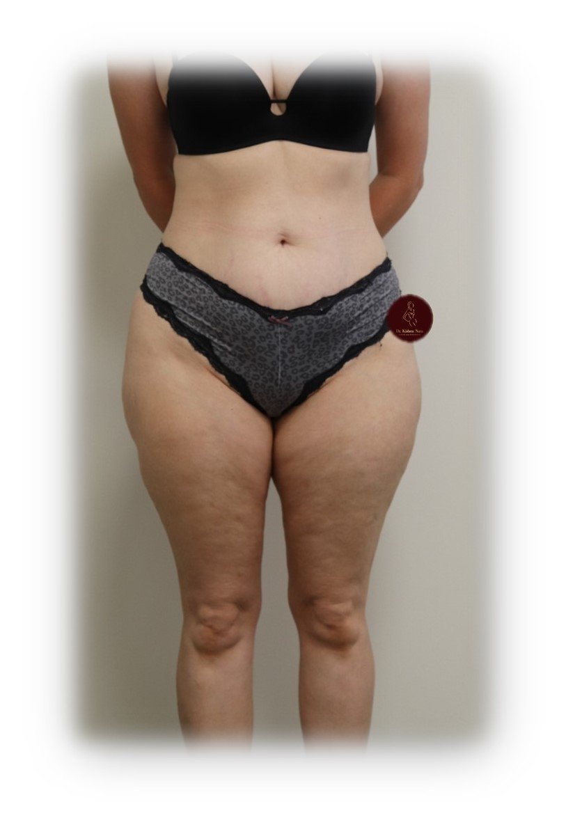 Outer-thigh liposuction — After · outer-thigh contour