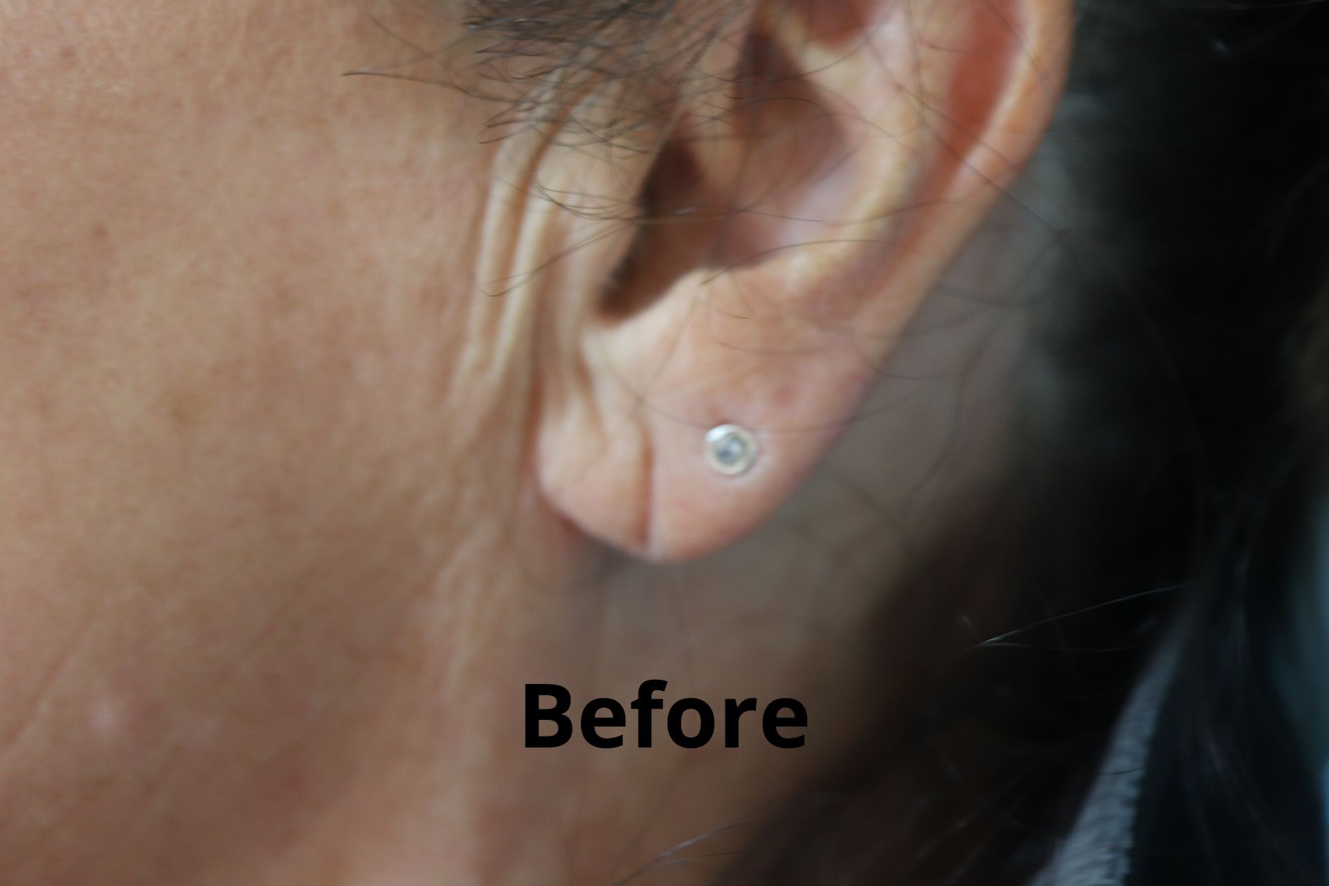 Ear lobe repair — patient two — Separate patient — before