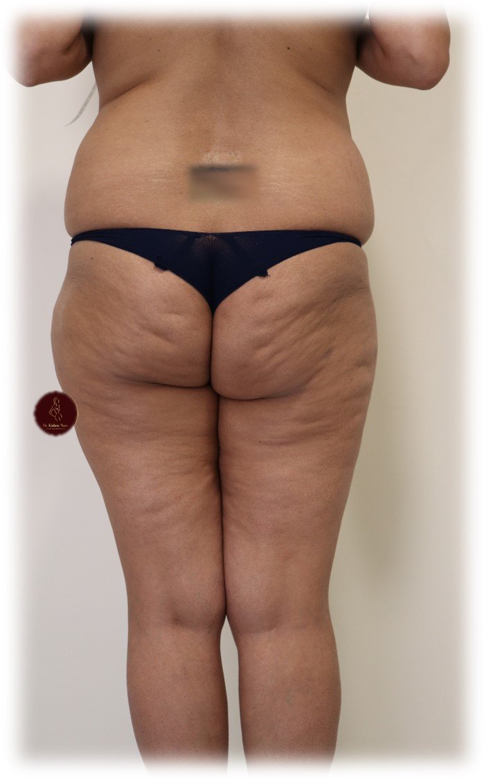 Inner-thigh + 360° liposuction — Before · inner-thigh contour