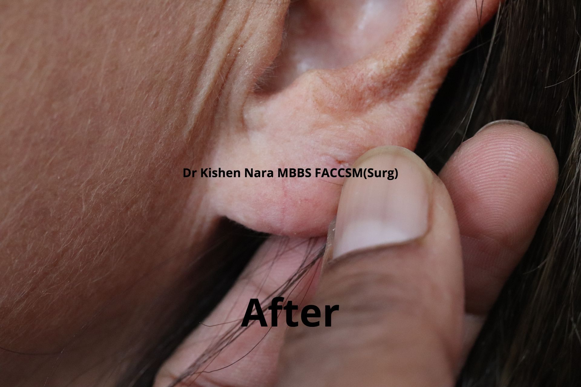 Ear lobe repair — patient two — Separate patient — after