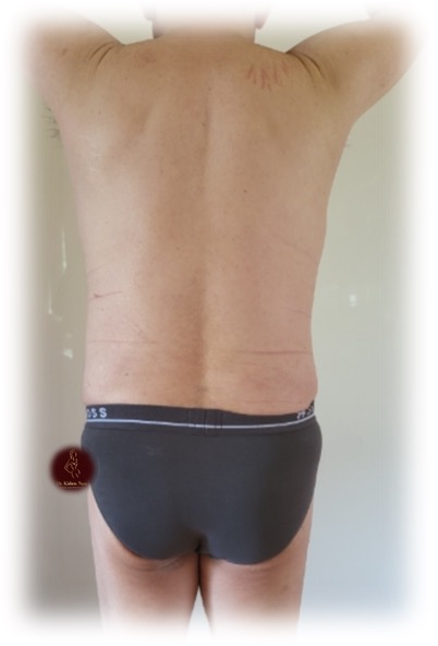 360° waist and abdomen liposuction — After · anterior view