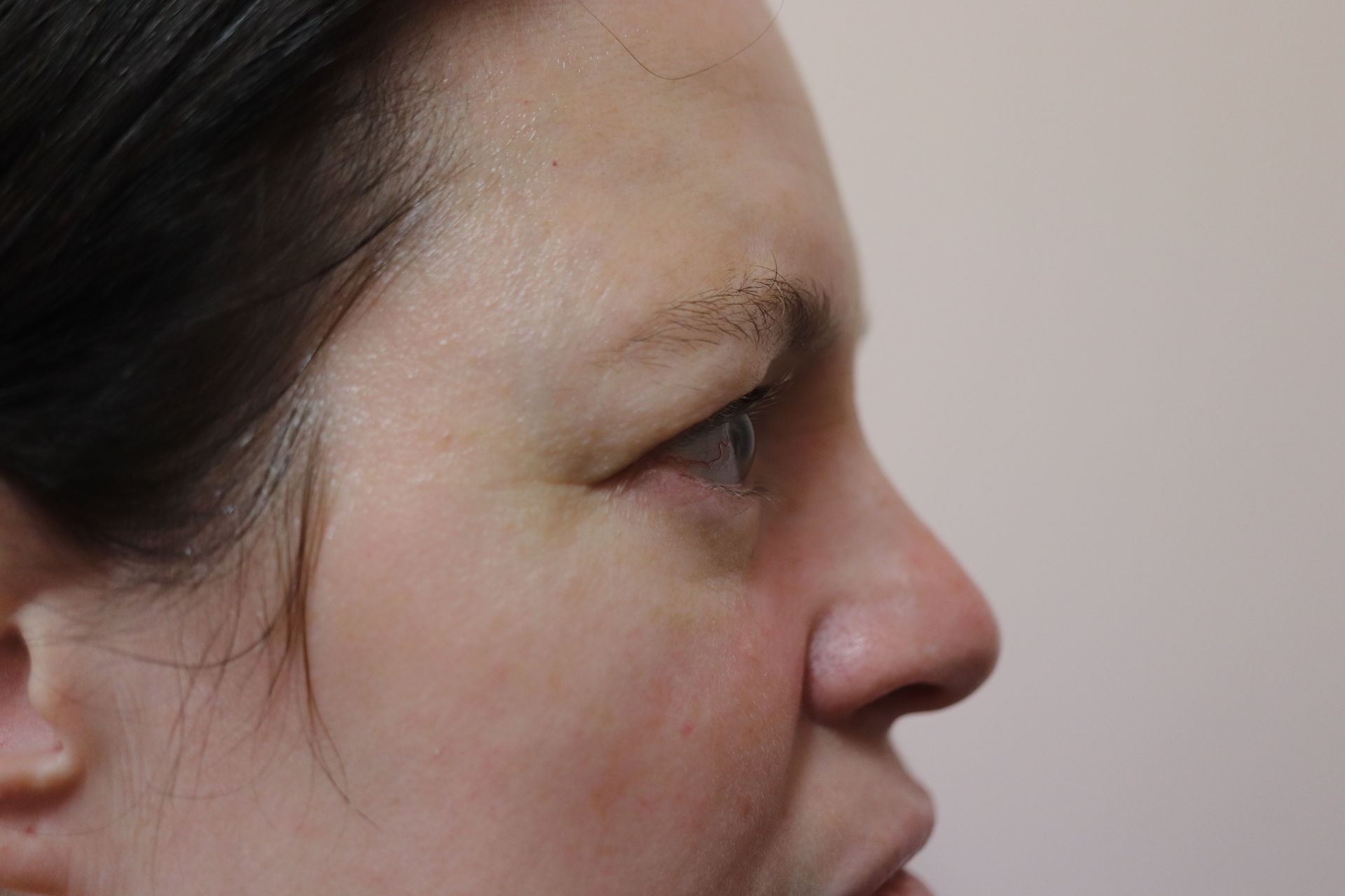 Upper blepharoplasty with triple-eyelid correction — 3 weeks post-procedure — before