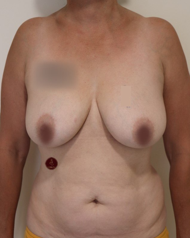 Breast lift (modified mastopexy) — third angle — before