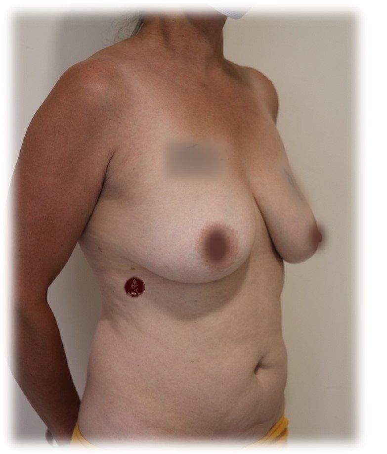 Breast lift (modified mastopexy) — Front view — before