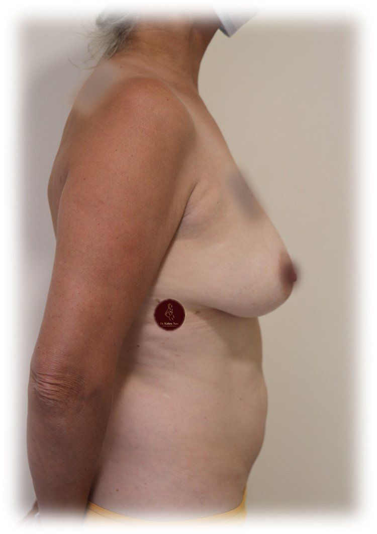 Breast lift (modified mastopexy) — side view — before