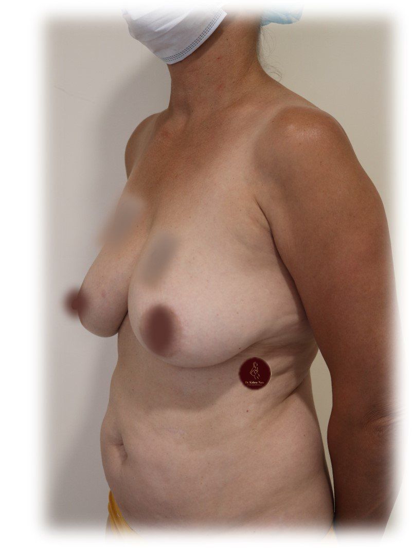 Breast lift (modified mastopexy) — fourth angle — before