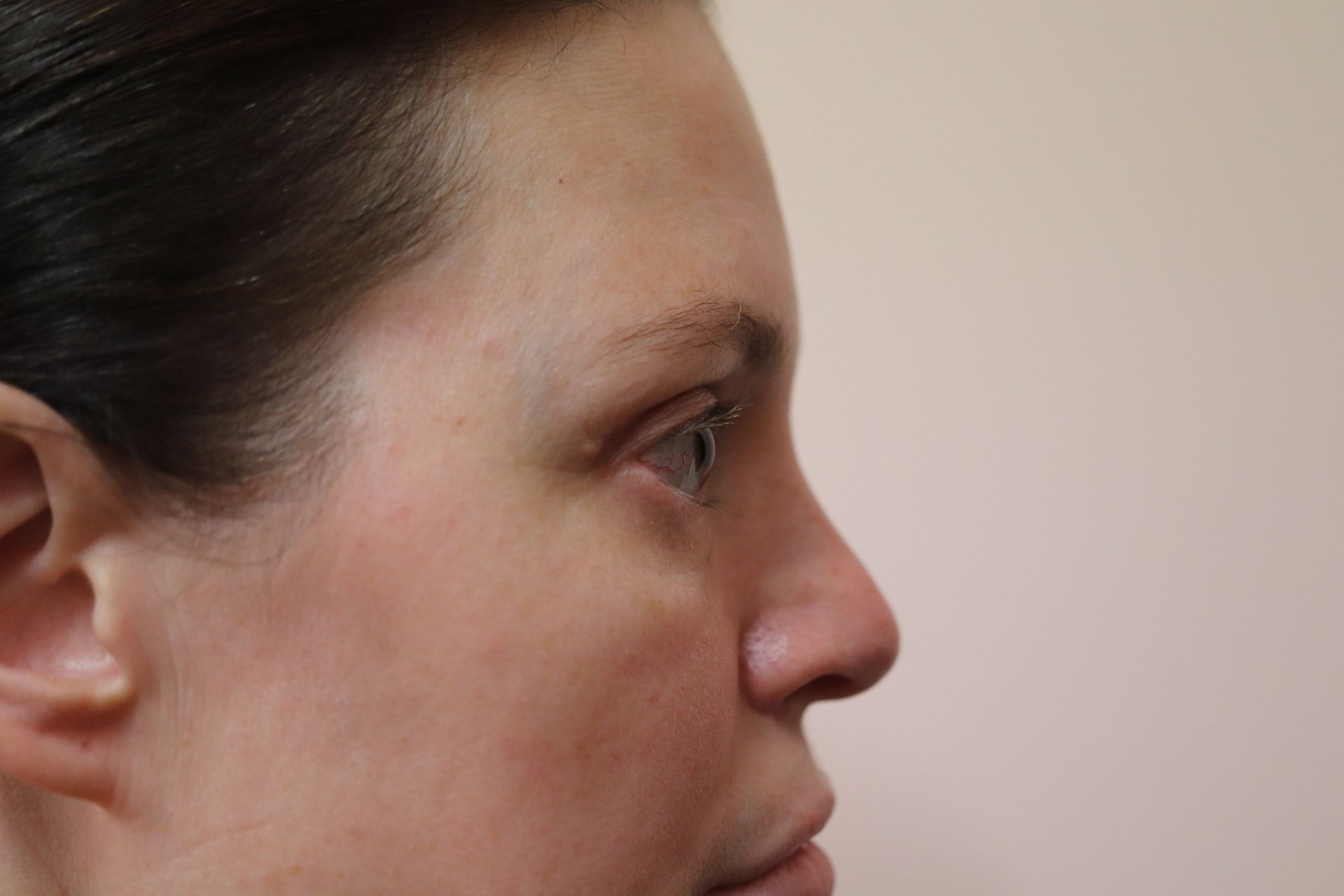 Upper blepharoplasty with triple-eyelid correction — 3 weeks post-procedure — after