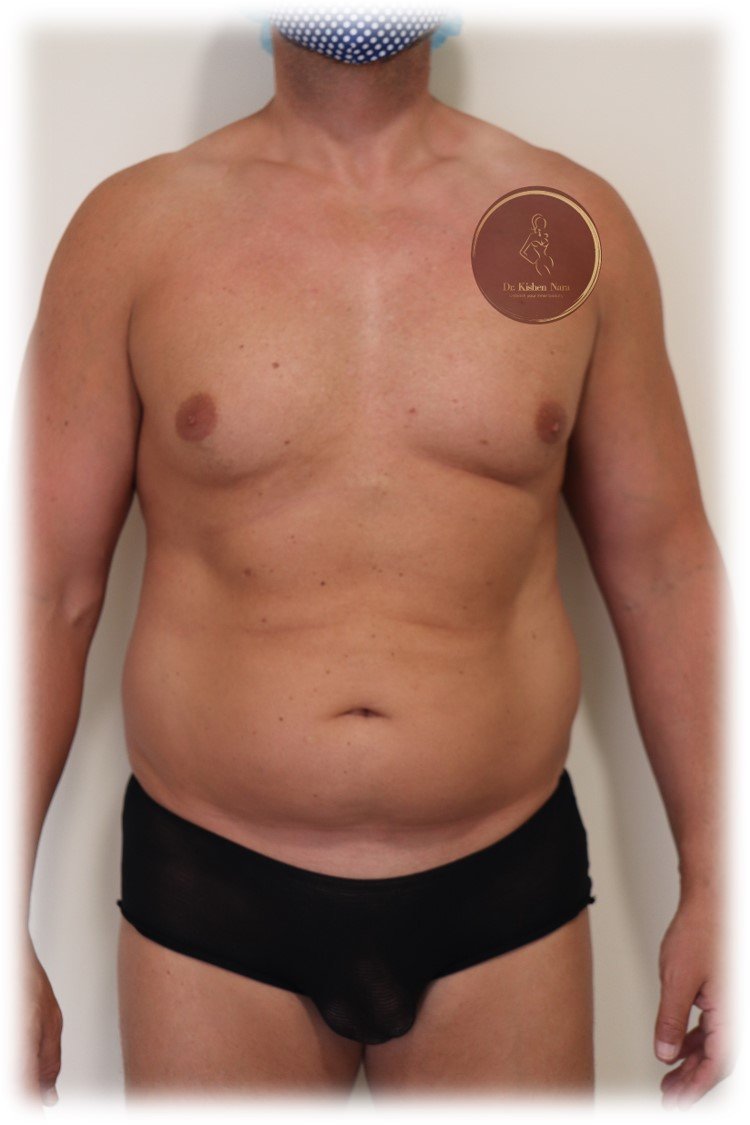 360° abdomen, waist and back liposuction — Before · front view