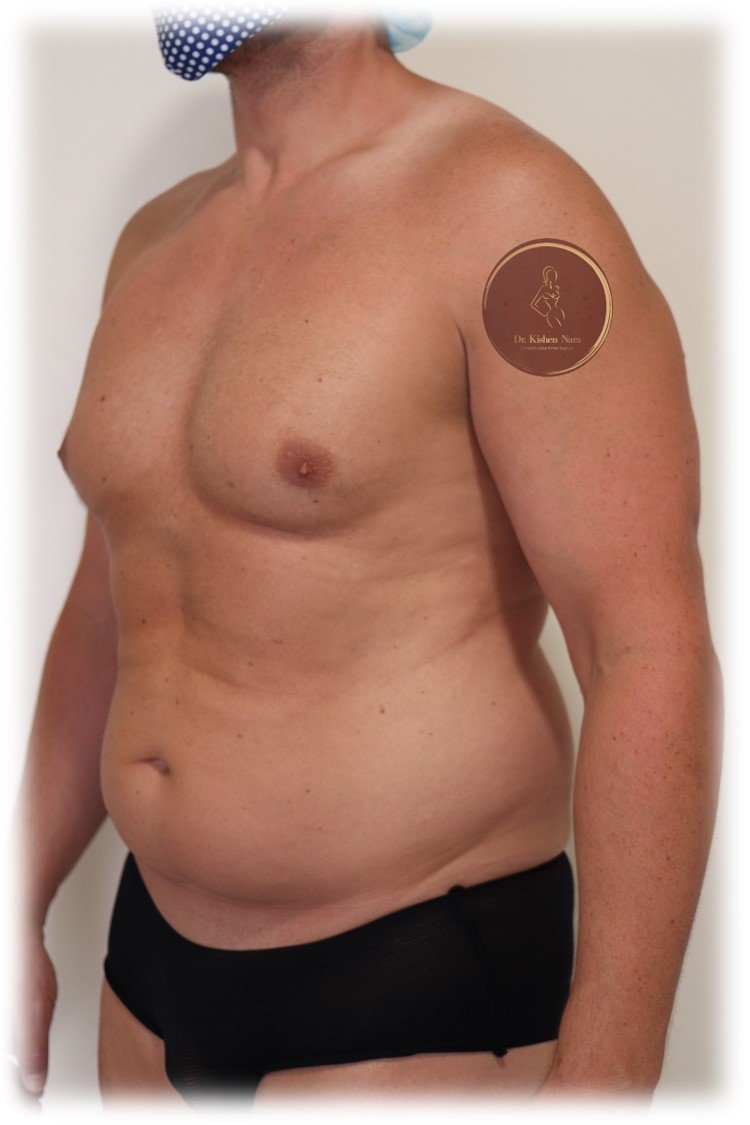 360° abdomen, waist and back liposuction — Before · oblique view