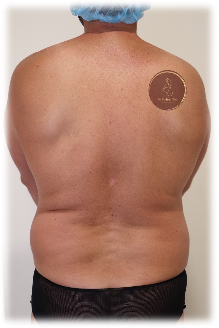360° abdomen, waist and back liposuction — Before · third angle