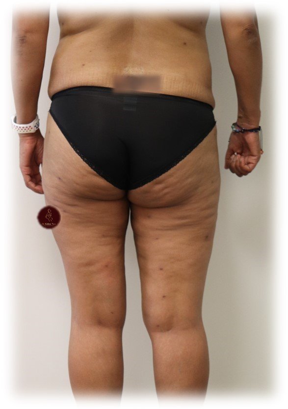Inner-thigh + 360° liposuction — After · inner-thigh contour