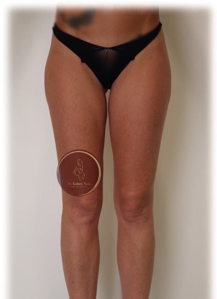 Inner-thigh liposuction — Before · inner-thigh contour