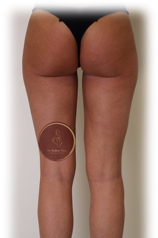 Inner-thigh liposuction — Before · second angle
