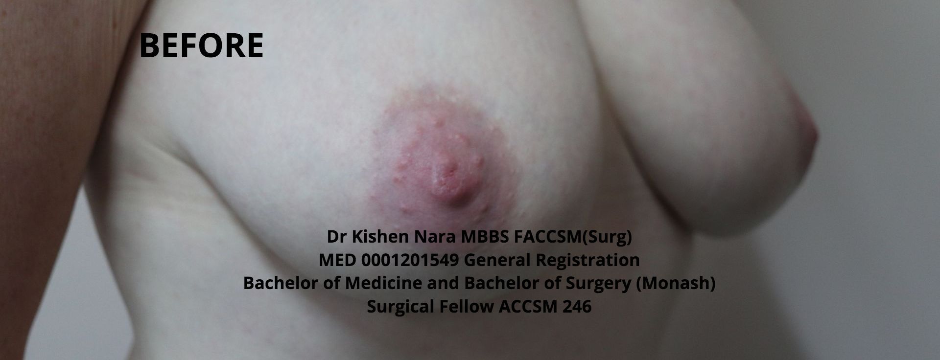 Nipple inversion correction (modified Pirelli) — second anterior angle — before