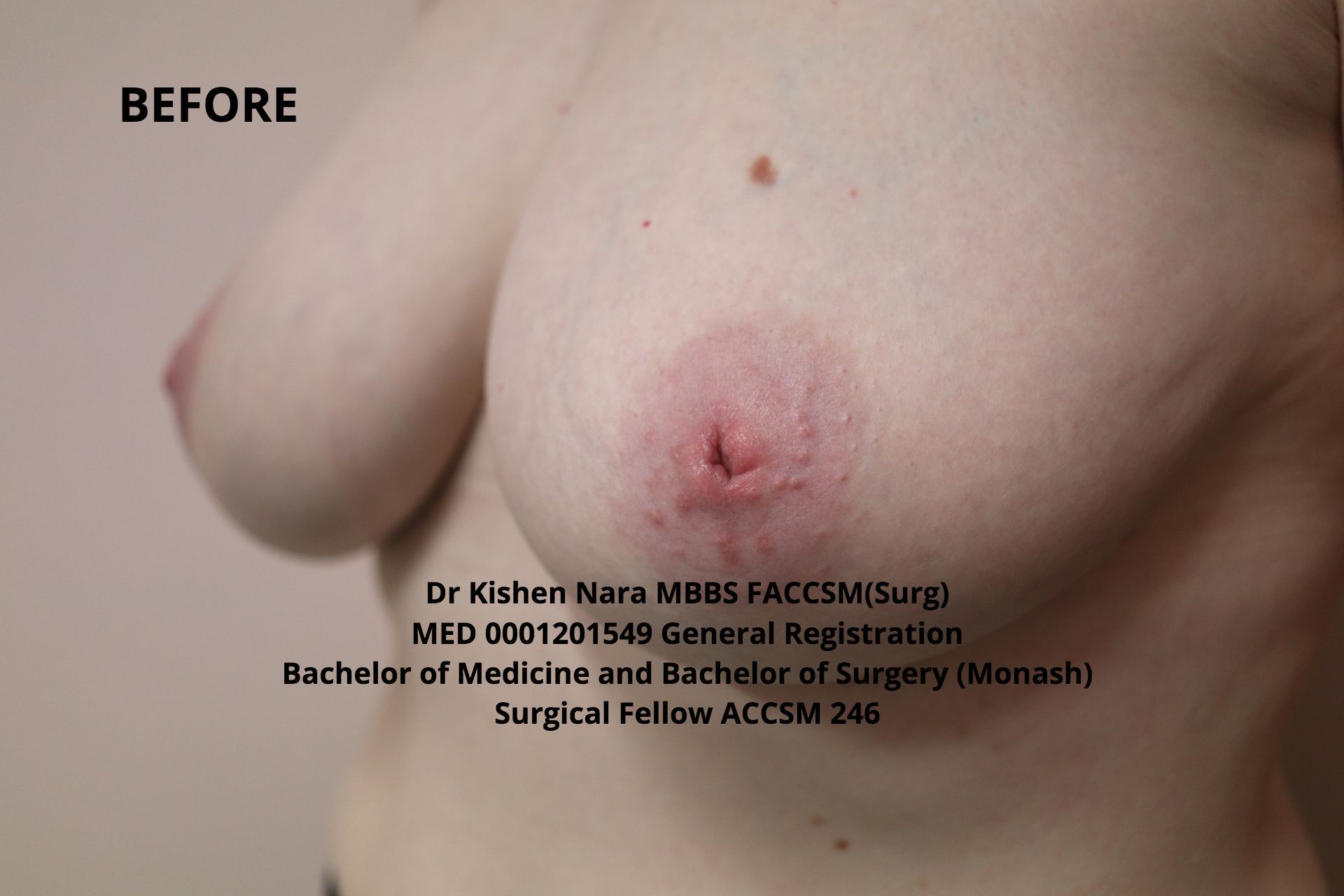 Nipple inversion correction (modified Pirelli) — 40-year-old mother of three — before