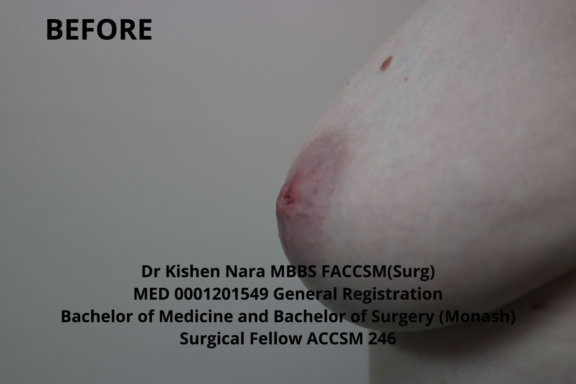 Nipple inversion correction (modified Pirelli) — third anterior angle — before