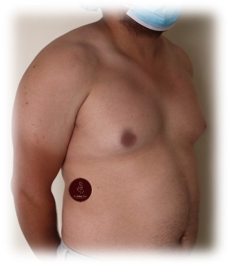 Gynaecomastia surgery with chest liposuction — Before · second angle