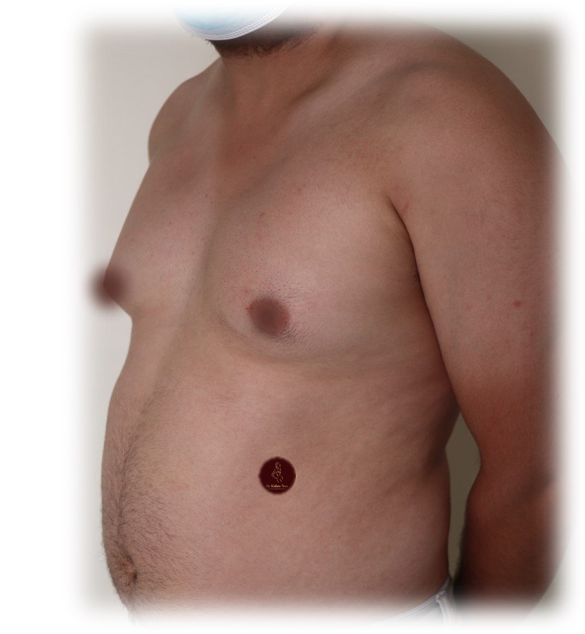 Gynaecomastia surgery with chest liposuction — Before · anterior view