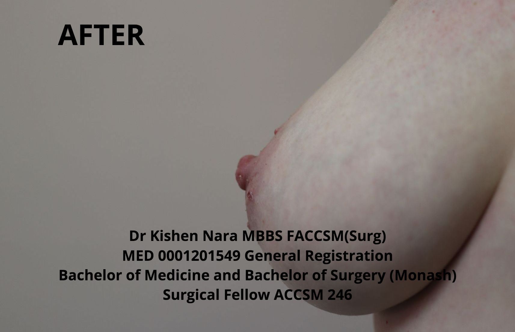 Nipple inversion correction (modified Pirelli) — oblique view — after