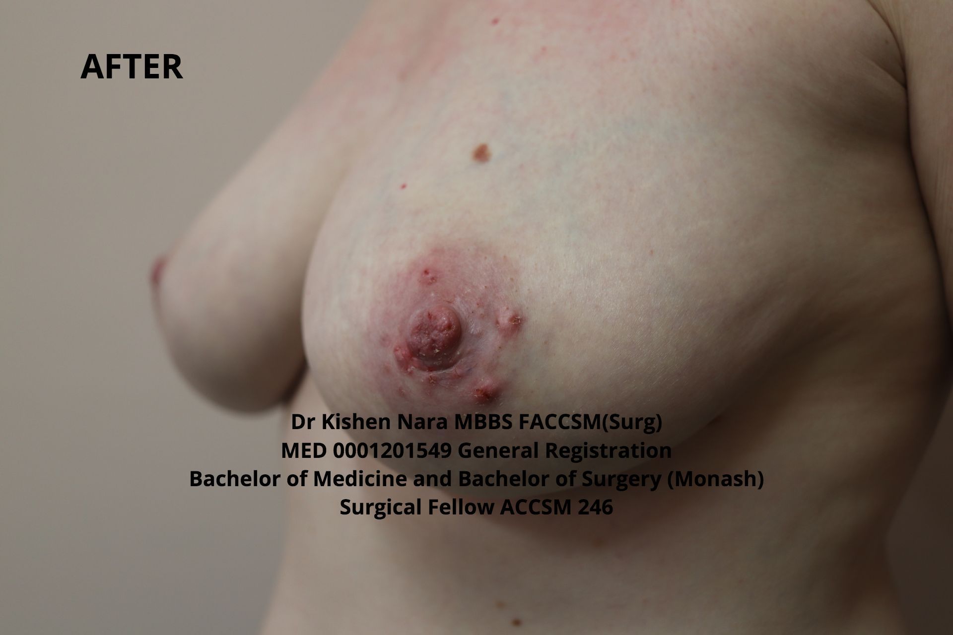 Nipple inversion correction (modified Pirelli) — 40-year-old mother of three — after