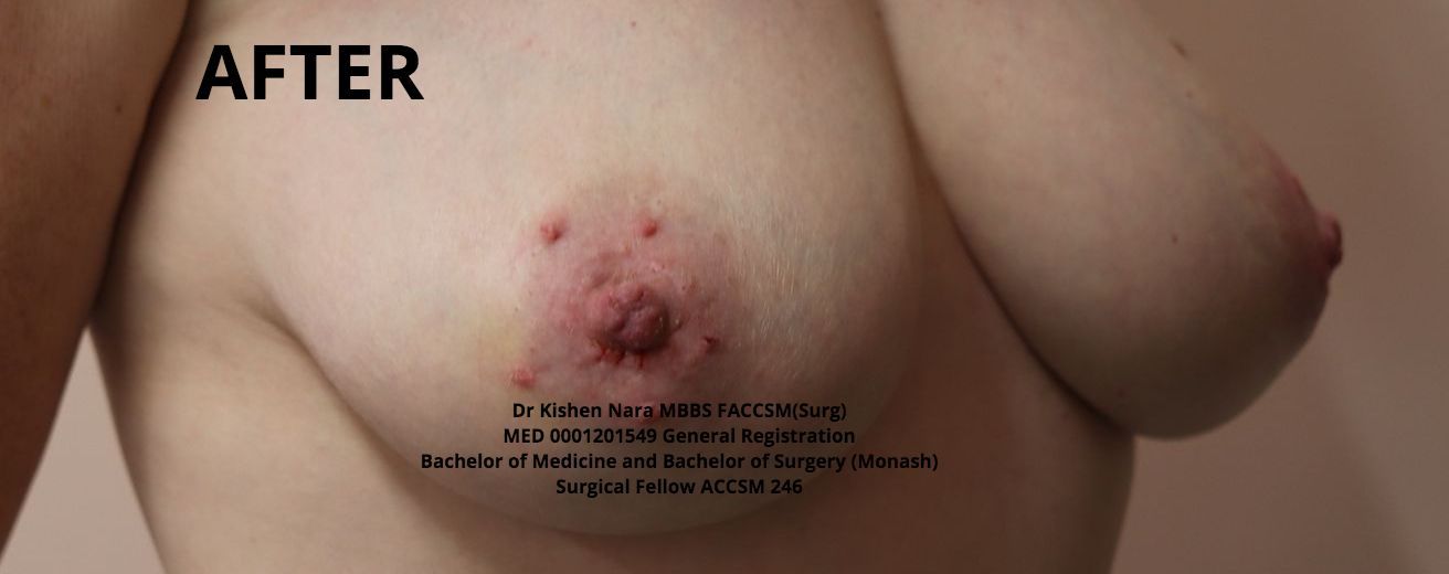 Nipple inversion correction (modified Pirelli) — second anterior angle — after