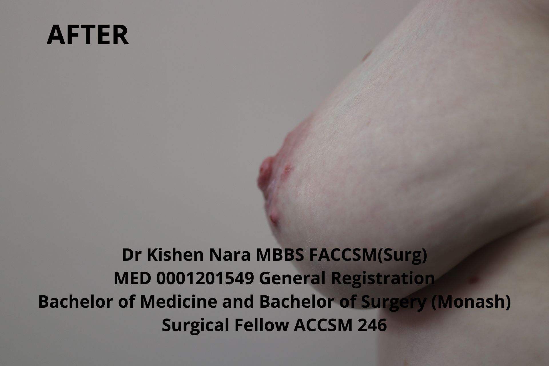 Nipple inversion correction (modified Pirelli) — third anterior angle — after