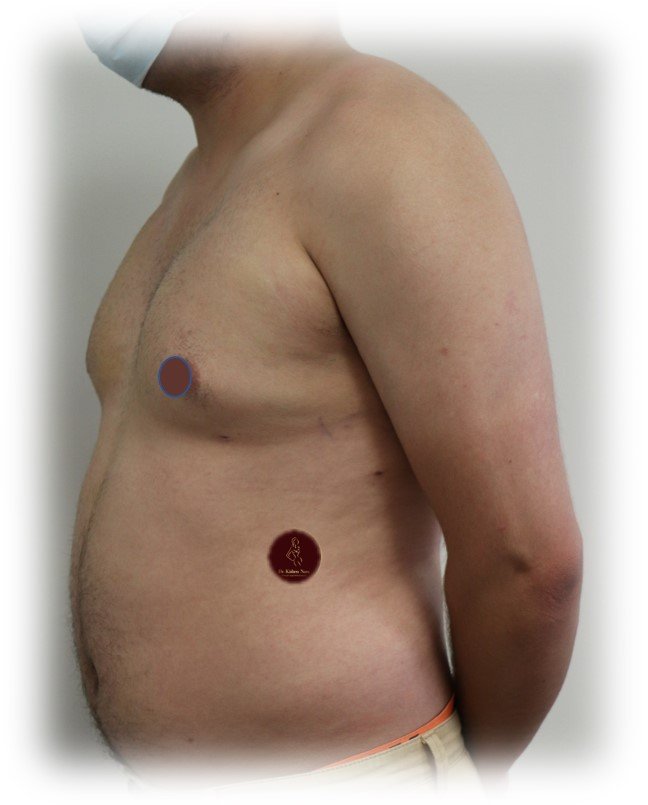 Gynaecomastia surgery with chest liposuction — After · anterior view