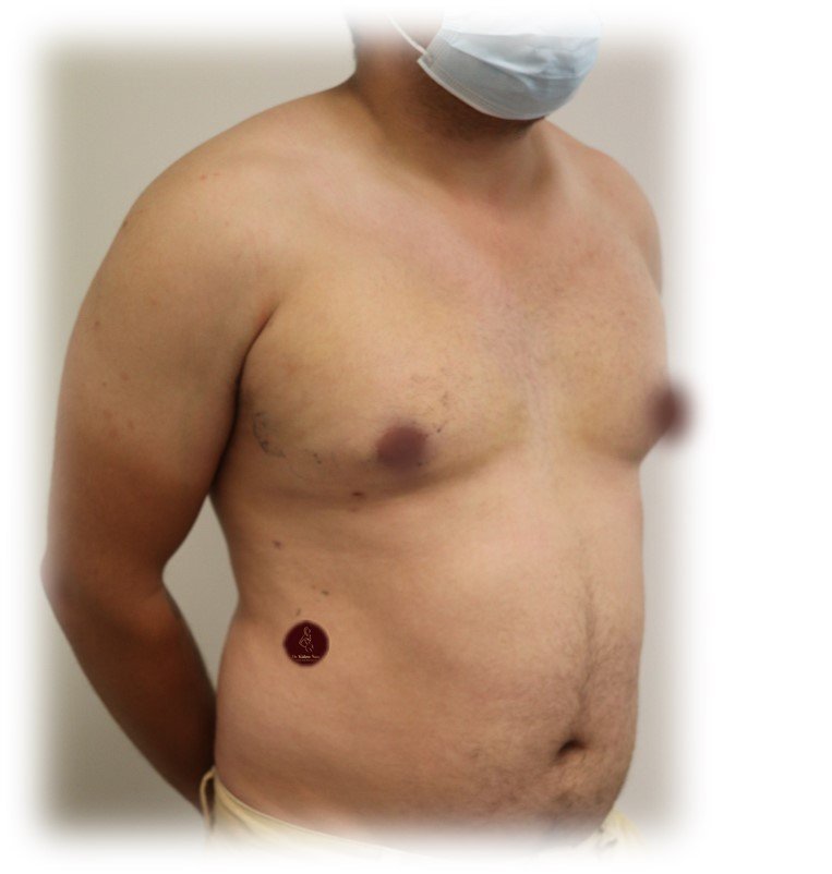 Gynaecomastia surgery with chest liposuction — After · second angle