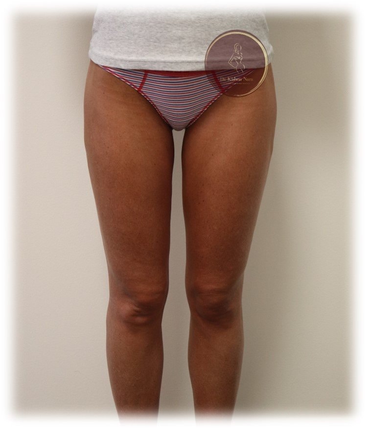 Inner-thigh liposuction — After · inner-thigh contour