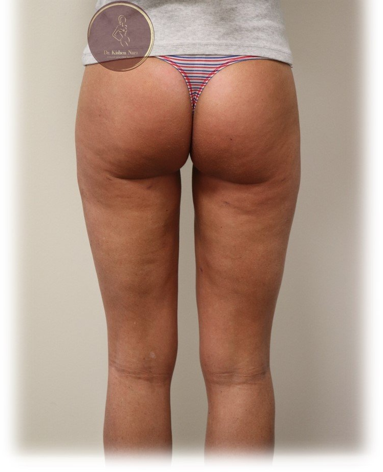 Inner-thigh liposuction — After · second angle