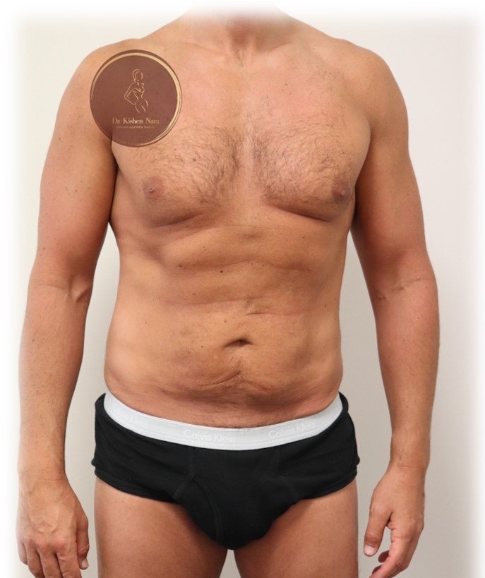 360° abdomen, waist and back liposuction — After · front view
