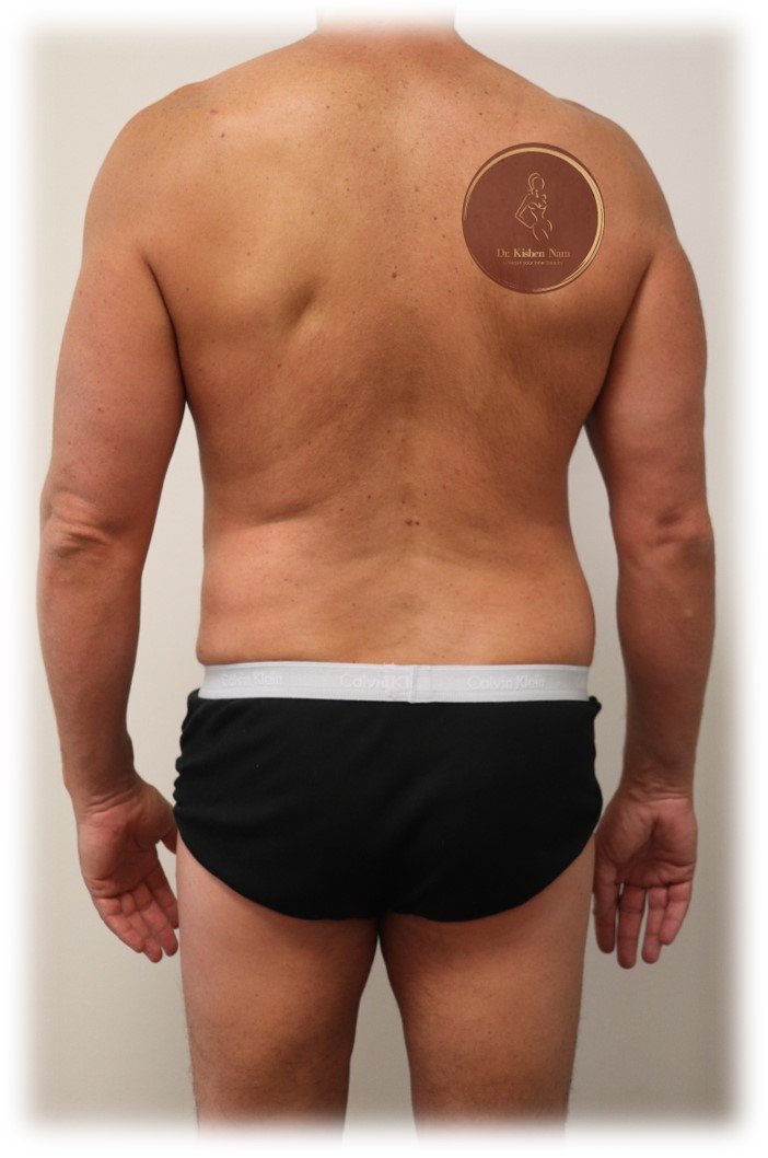 360° abdomen, waist and back liposuction — After · third angle