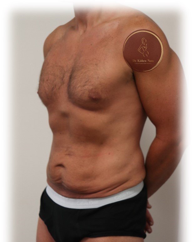 360° abdomen, waist and back liposuction — After · oblique view