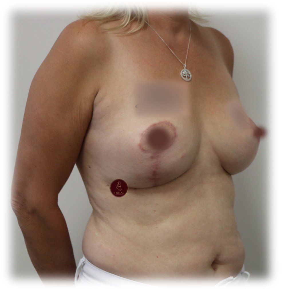 Breast lift (modified mastopexy) — Front view — after