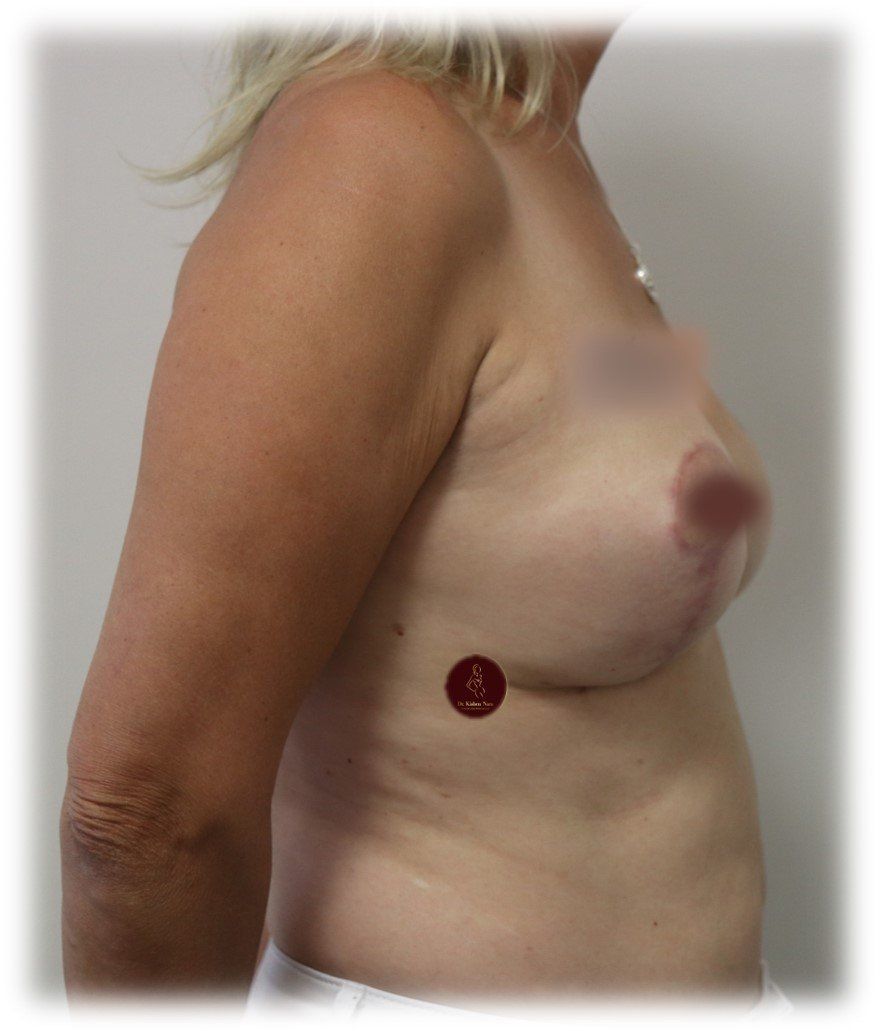 Breast lift (modified mastopexy) — side view — after