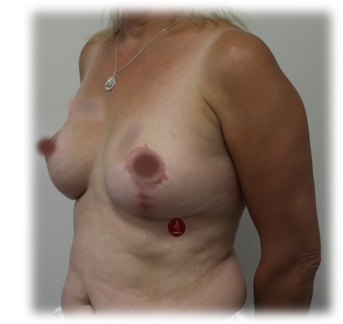 Breast lift (modified mastopexy) — fourth angle — after