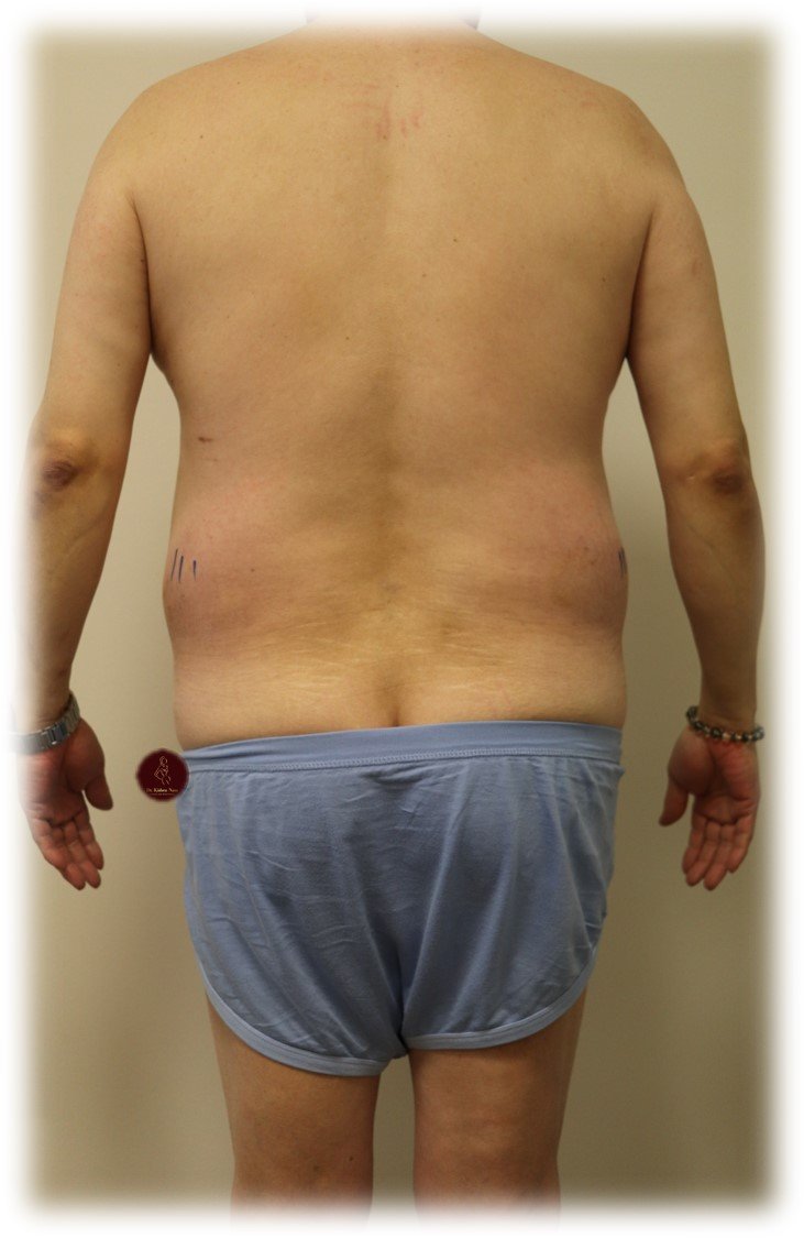 360° waist and abdomen liposuction — Before · anterior view
